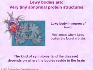 Image of a Lewy body in a neuron of the brain.